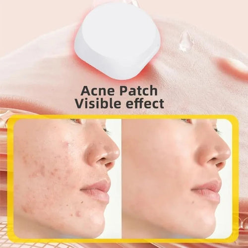Pimple-Pop